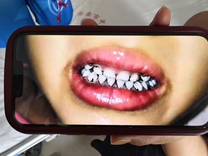 A parent shows the black substance appearing between their child&rsquo;s teeth.
